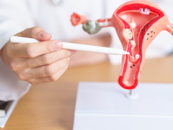 Doctor with Uterus and Ovaries anatomy model. Ovarian and Cervical cancer, Cervix disorder, Endometriosis, Hysterectomy, Uterine fibroids, Reproductive system, Pregnancy and health concept